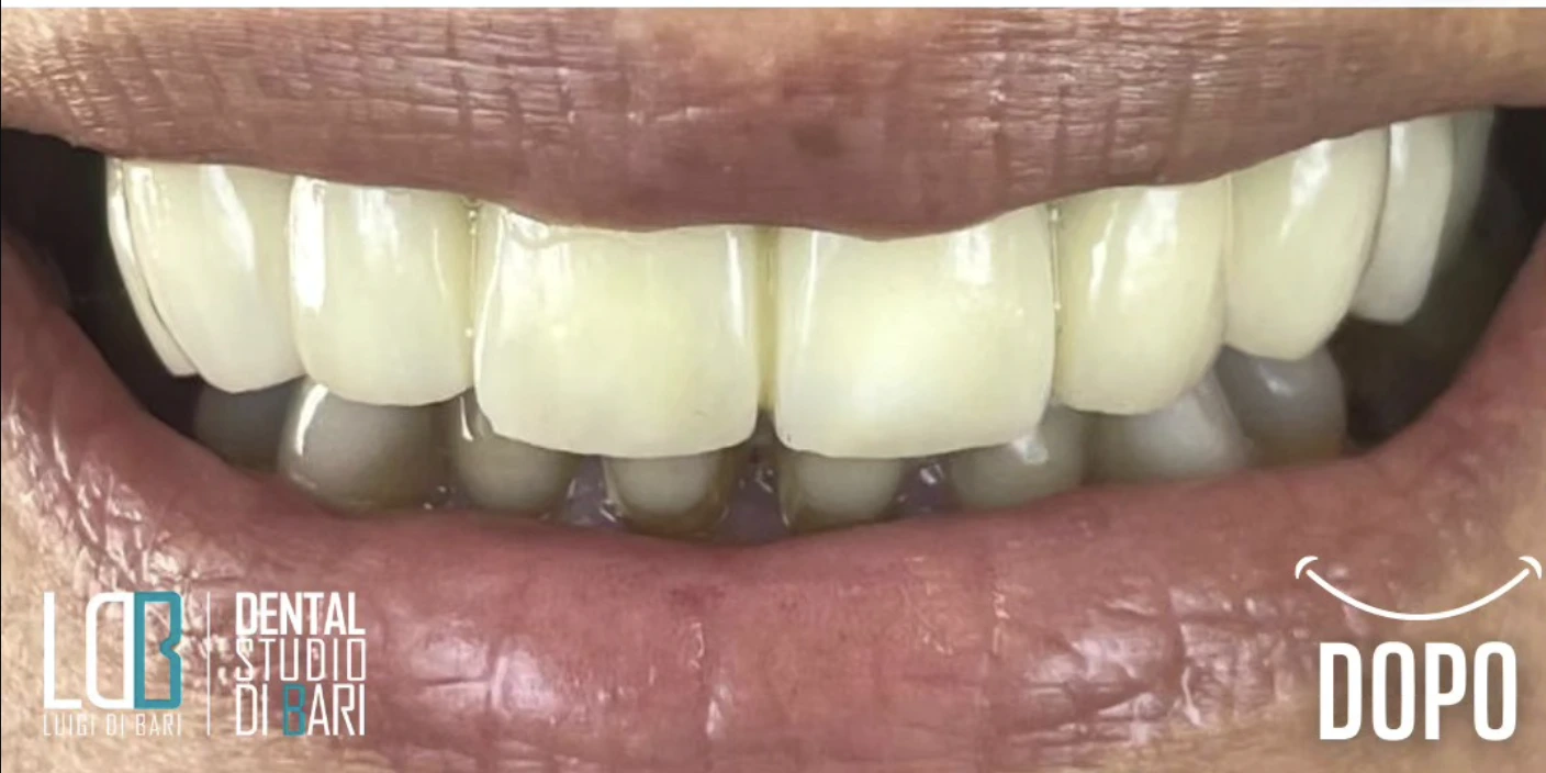Faccette ceramica prima e dopo - Studio Dr. Luigi di Bari